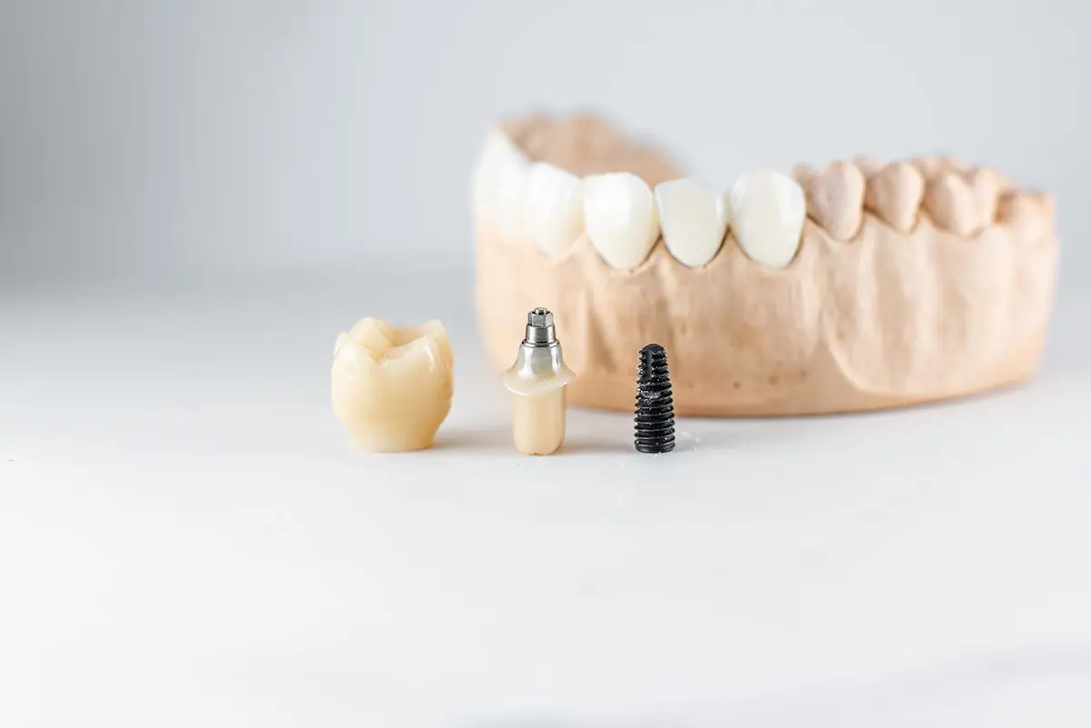 3model-of-artificial-jaw-and-dental-implant-2023-11-27-05-19-37-utc