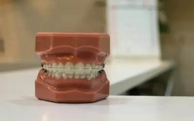 How Much Do Braces Cost in Ottawa?
