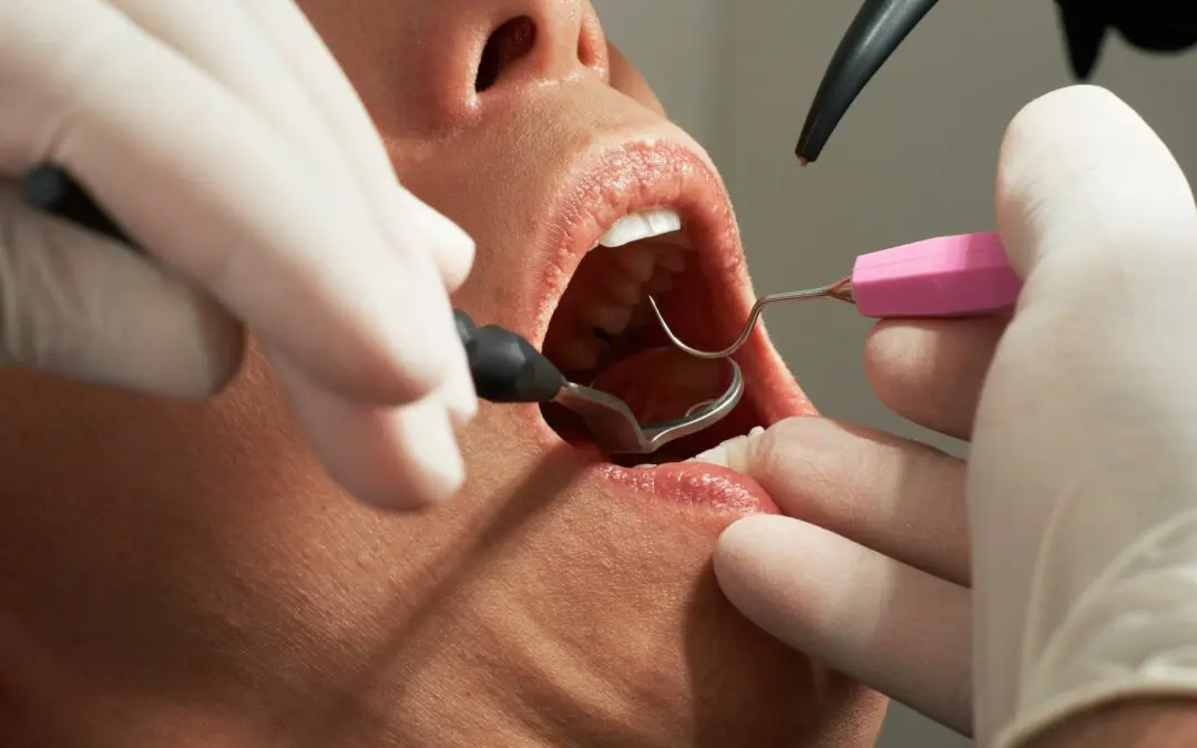 Composite Fillings vs. Amalgam Fillings: What’s the Best Choice for Your Smile?