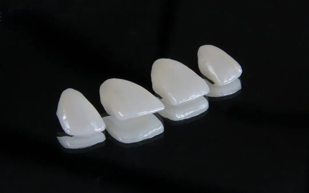 Dental Bonding vs Veneers: What’s Right for Your Smile?