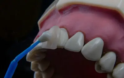 Everything You Need to Know About Getting Dental Veneers in Barrhaven