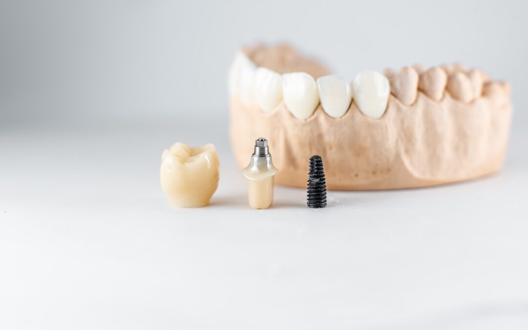 How much do dental implants cost in Ottawa?