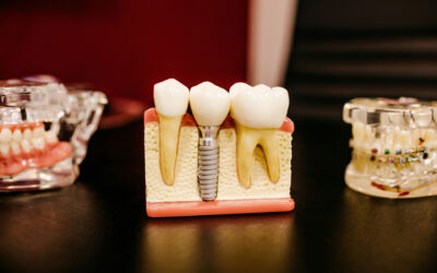 How Much Does a Root Canal Cost in Ottawa?